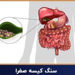 پک سنگ صفرا