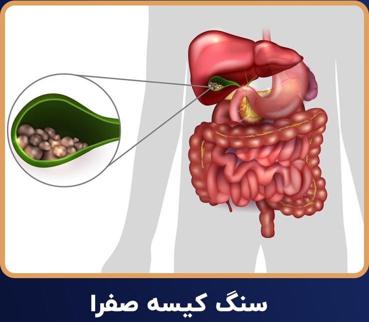 سنگ-کیسه-صفرا (2) پک سنگ صفرا - Image 1